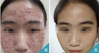 選對醫院擺脫痤瘡 再現無瑕美肌