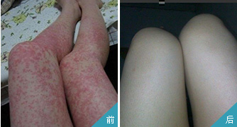 臉上出現過敏應該怎么辦才好