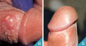 男性夏季皮膚病多發 莫與性病混淆